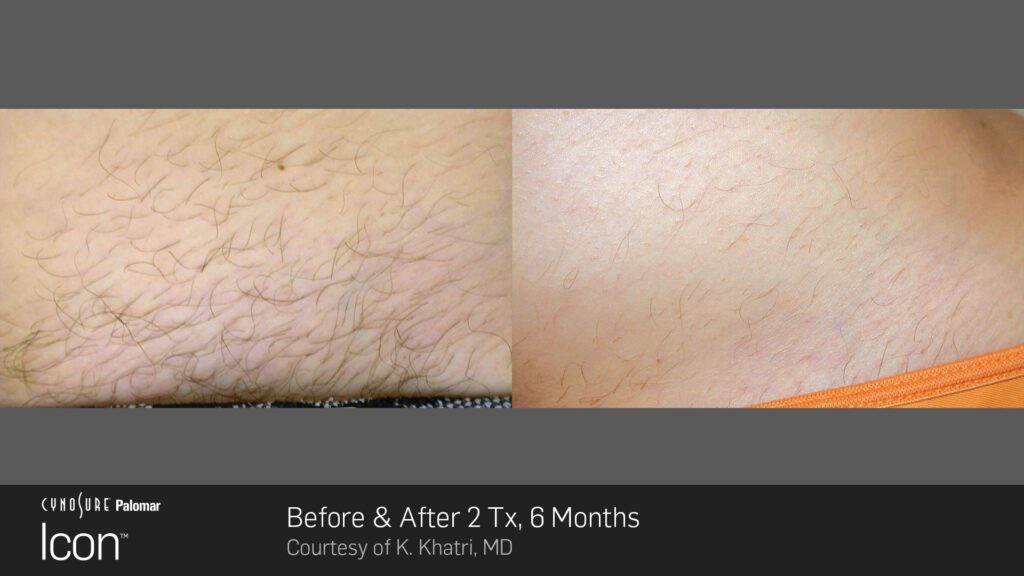 hair-removal-before-after-photo-7